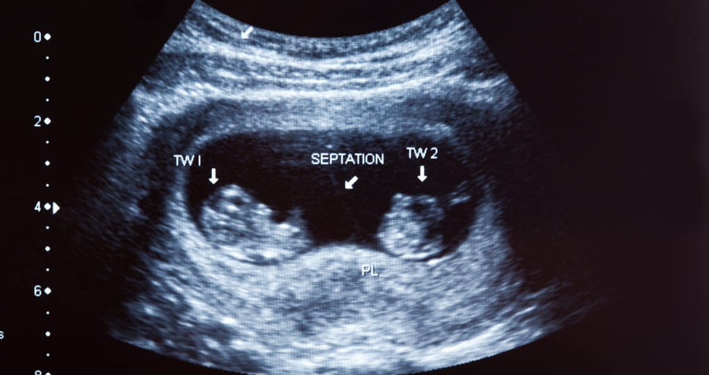 ¿Qué considerar si deseas un embarazo gemelar en  El Salvador?